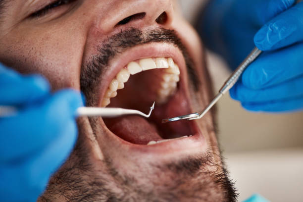 Best Emergency Treatment for Dental Infections or Abscesses in Rochester, WI